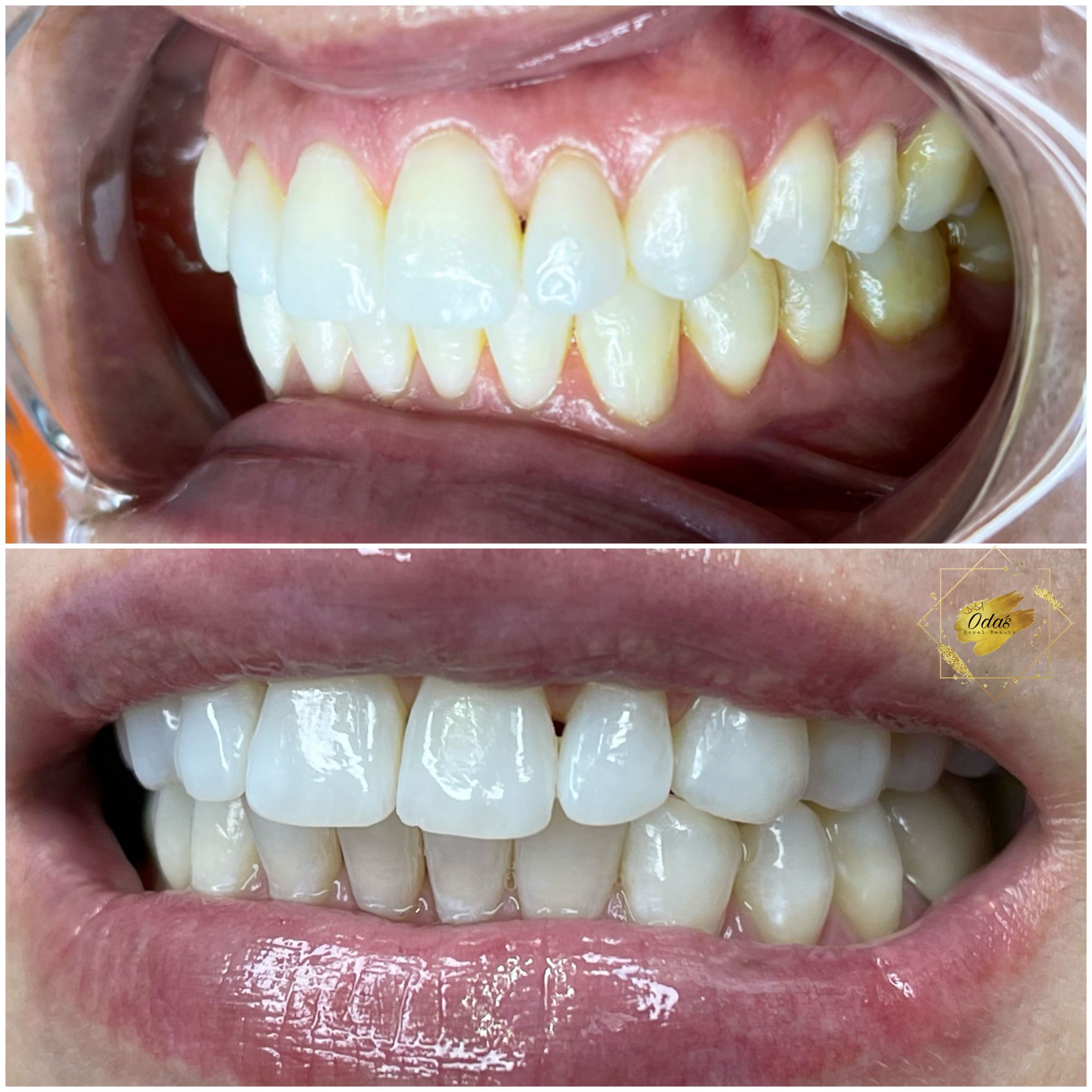 Cosmetic teeth Whitening/ Aclaramiento Dental portfolio