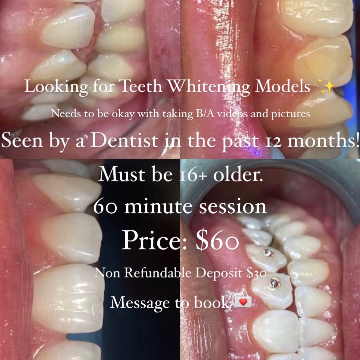 Model - Teeth Whitening portfolio