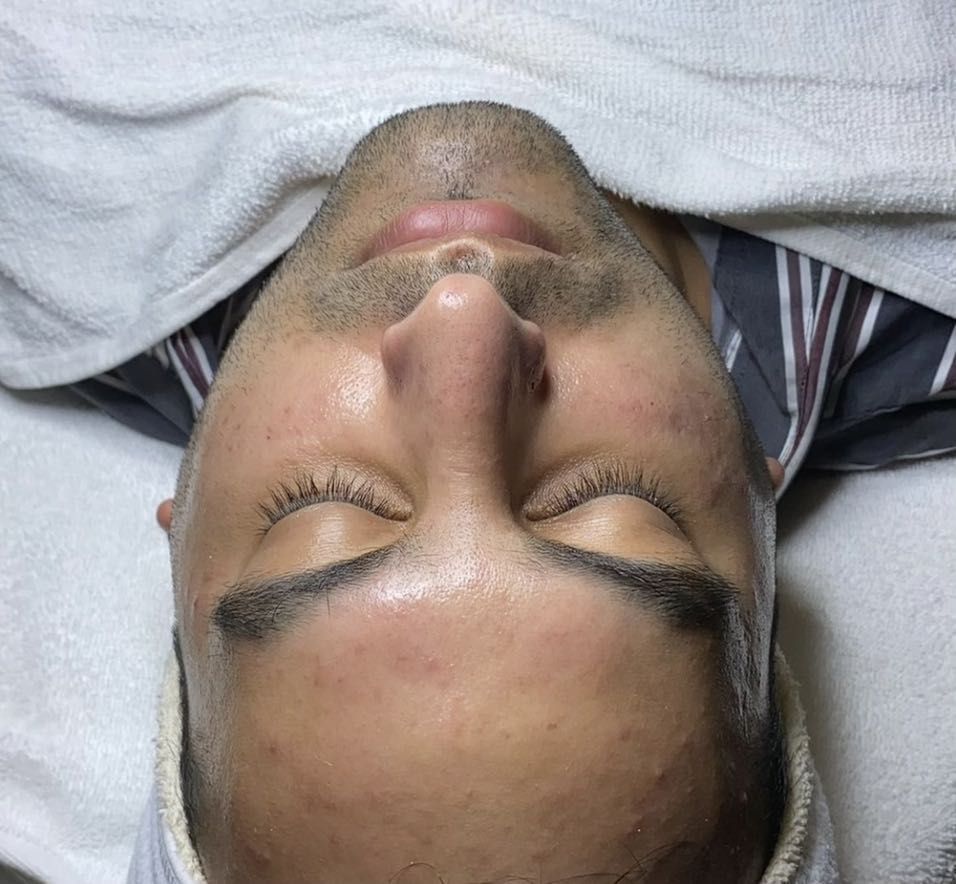 Men's Acne Treatment includes hands/arm message portfolio
