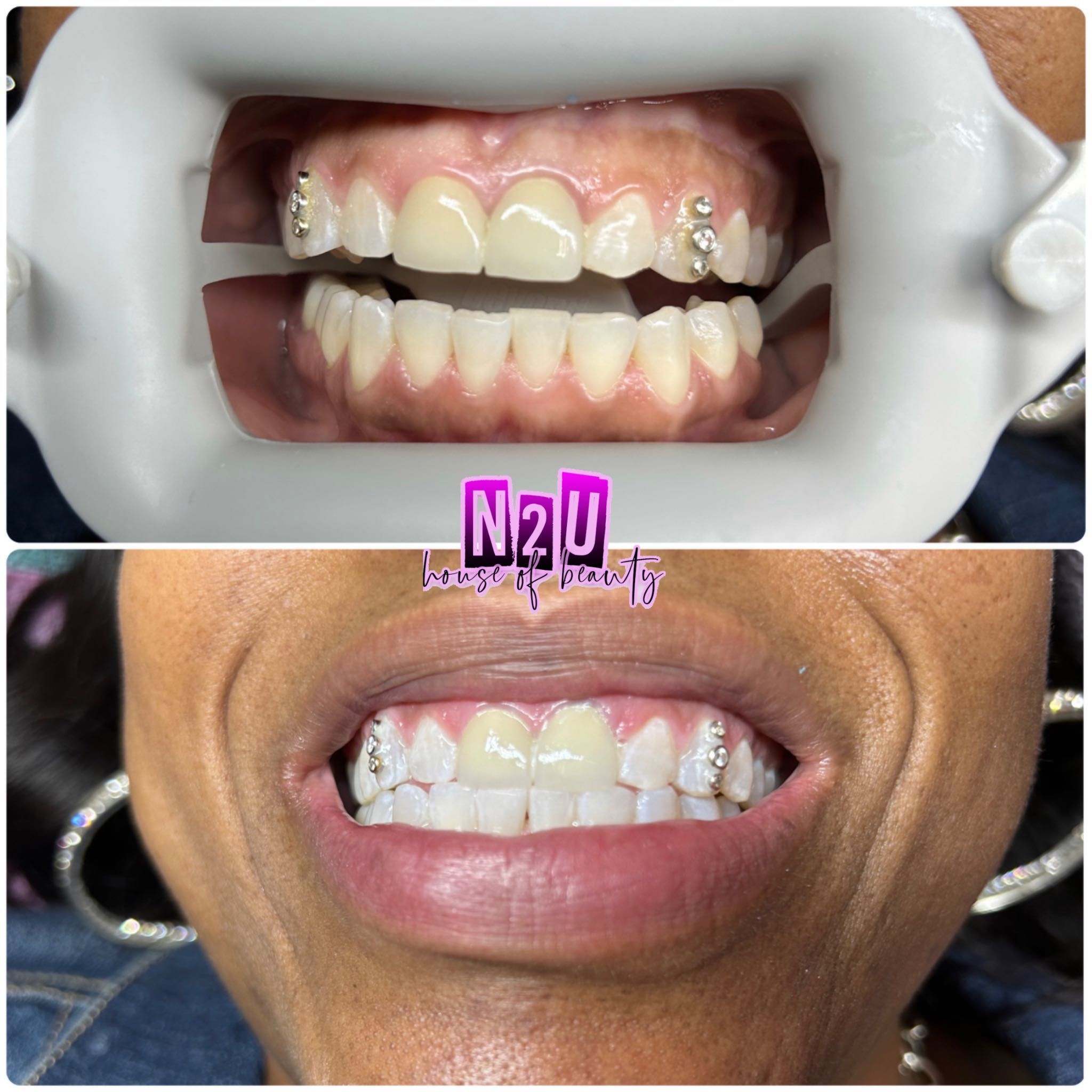 Ultrasonic SINGLE Teeth Whitening portfolio