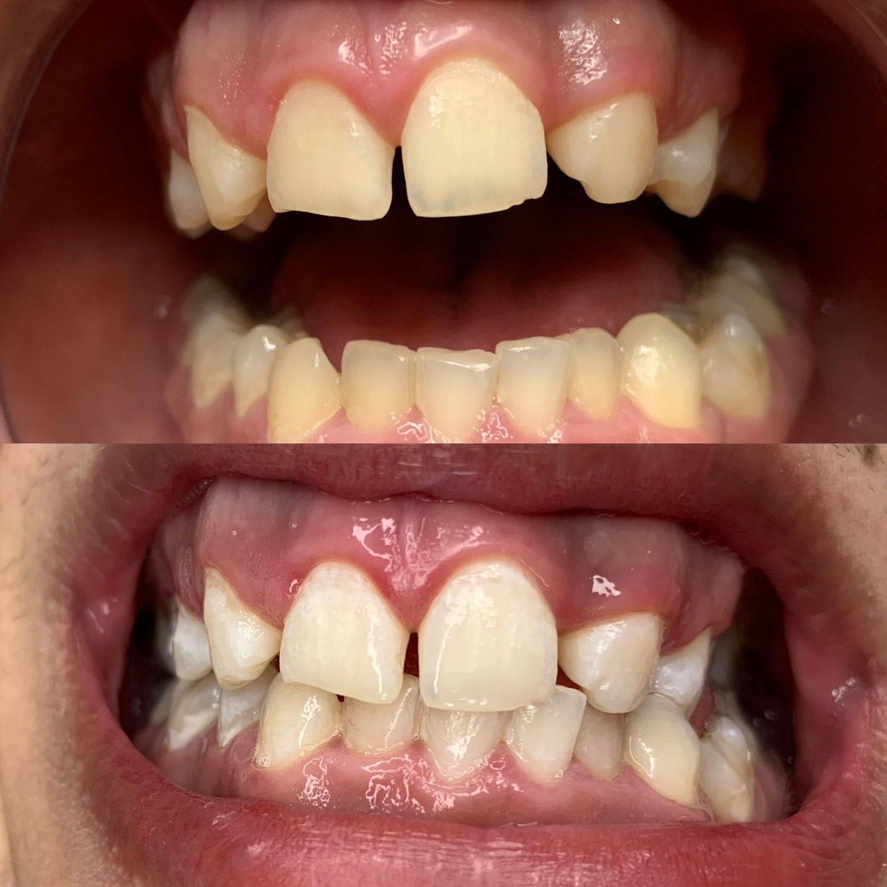Teeth Withening/ Blanqueamiento Dental 30% OFF portfolio