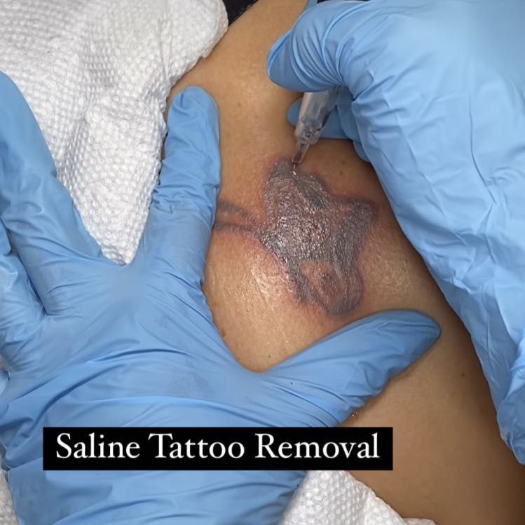 Tattoo removals - Ghost Saline solution portfolio