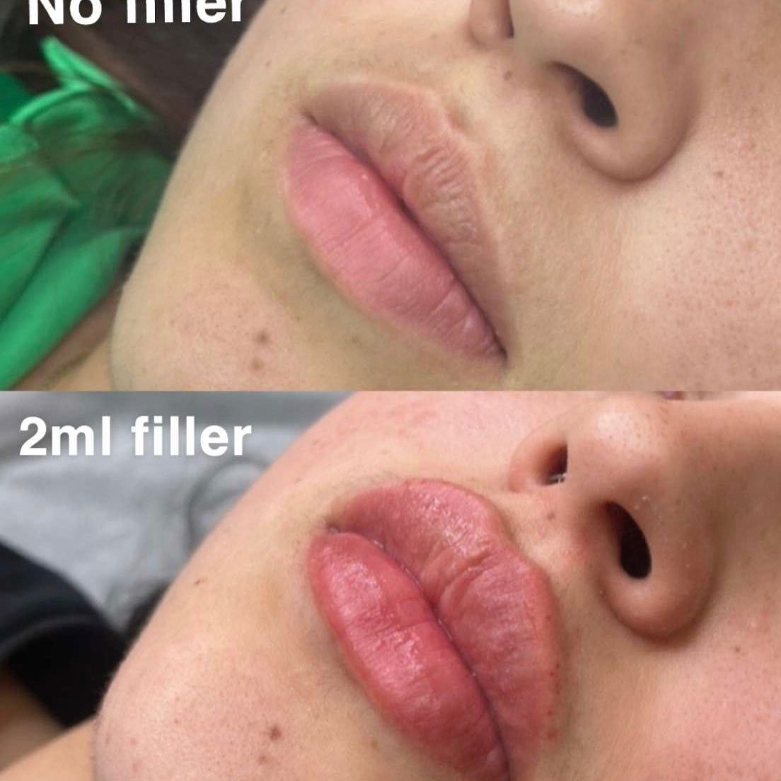 Lips Hyapen Filler 1ml - New Client portfolio