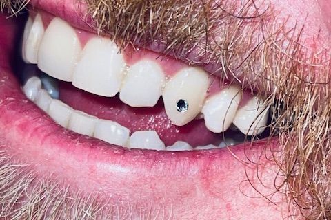 Multiple Tooth Gems (2 or more) portfolio