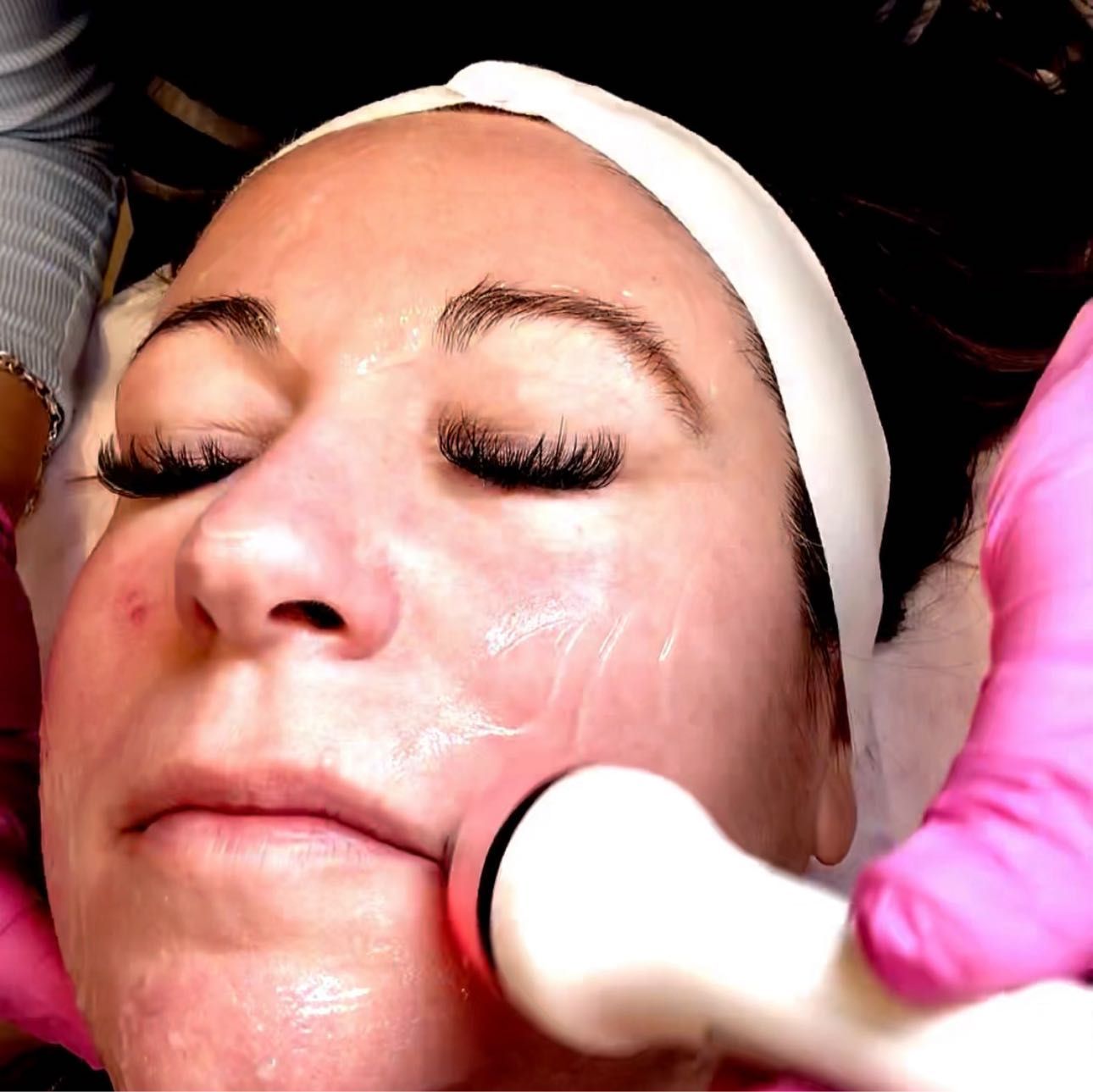 Face Skin tightening treatment portfolio