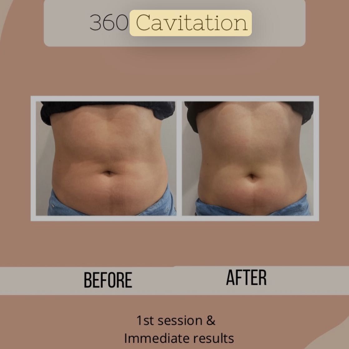 Body contouring Package 7 sessions portfolio
