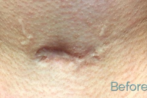 Scar Reduction Skin needling for the Body portfolio