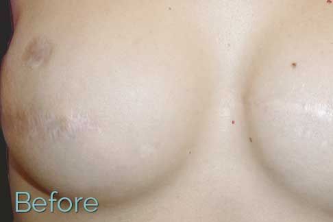New Cosmetic Tattoo Work - Nipples and Areolas portfolio