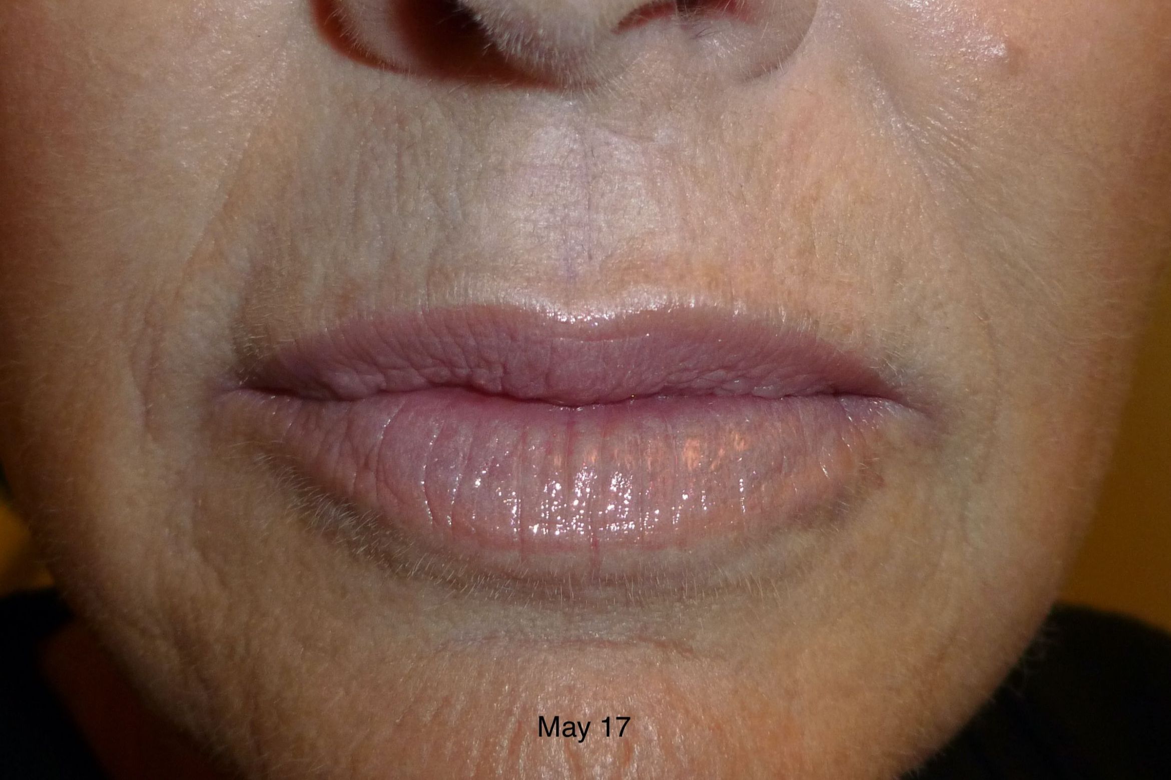 Skin Needling Facial Treatment portfolio
