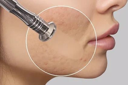 ADD-ON: MICRODERMABRASION ADDED TO A  FACE PEELING portfolio