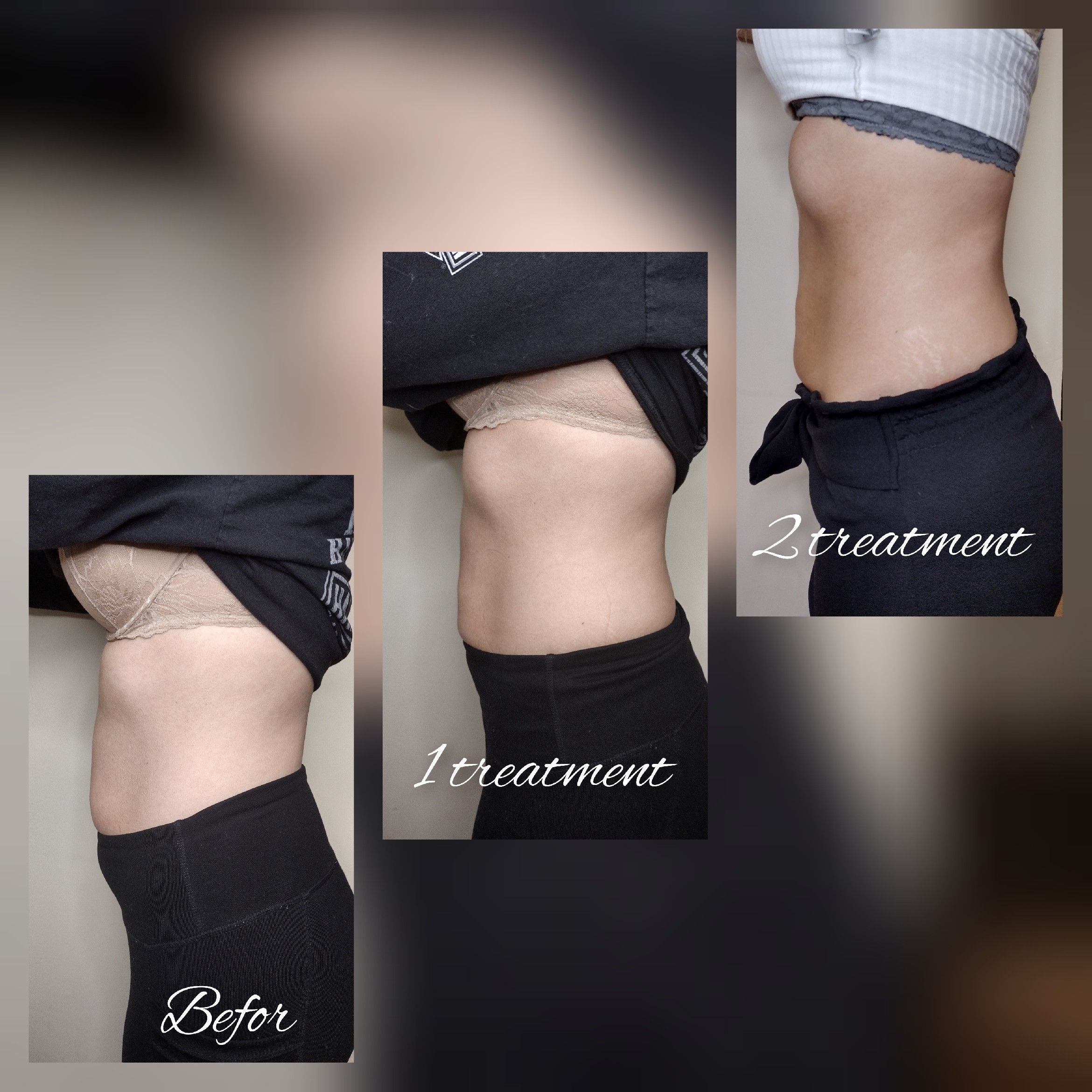 Fat Removal Legs/Stomach/Arms/Chin (1 Area) portfolio