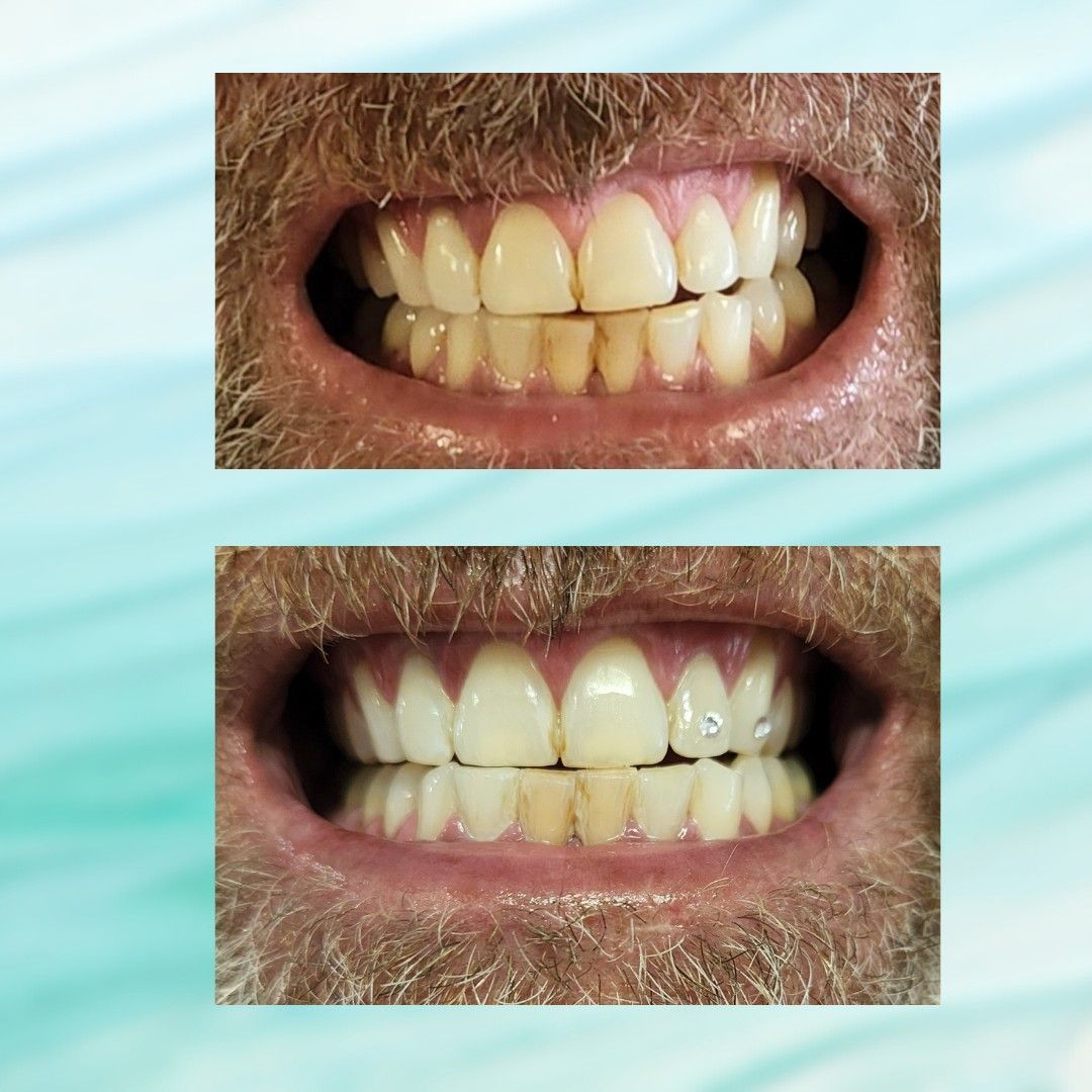 teeth whitening with 1 gem portfolio