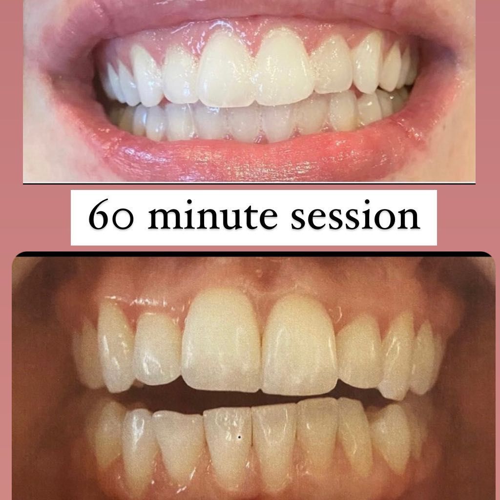 Teeth Whitening 1 Hour SPECIAL portfolio