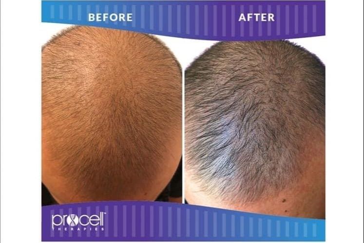 ProCell Microchanneling For Hair Loss portfolio