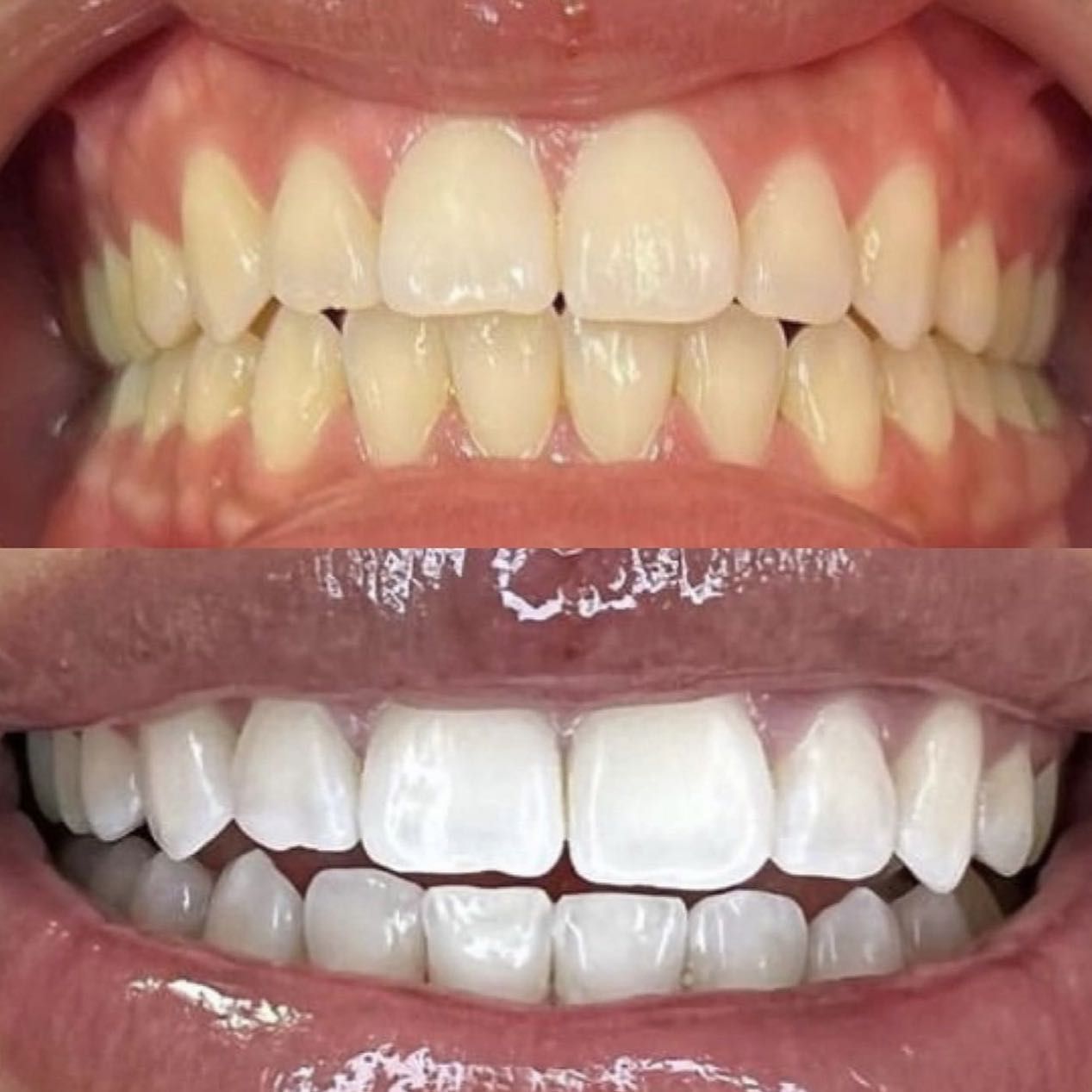 Teeth Whitening 60 min session portfolio