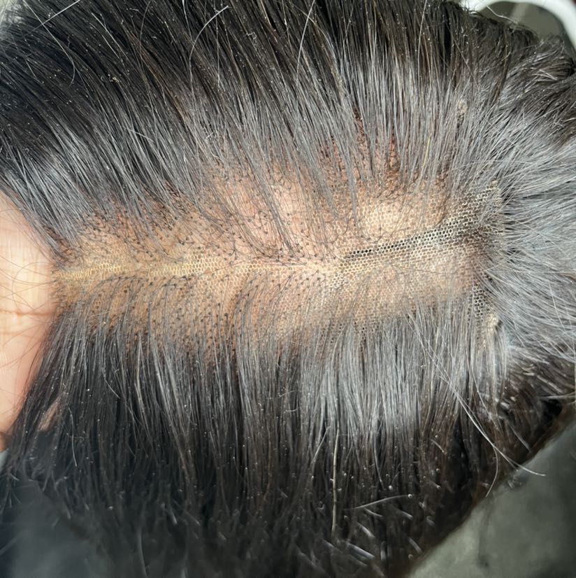 Wig Repair (Baldness) portfolio