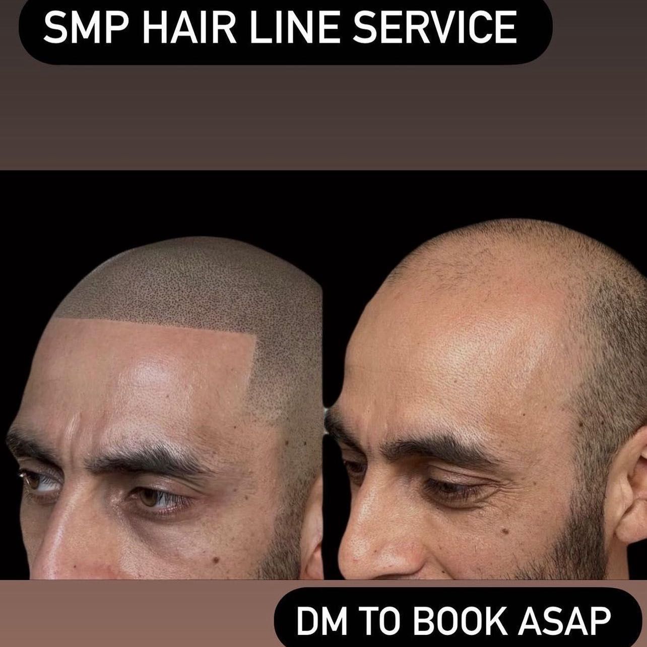 SMP hair line tattoo portfolio