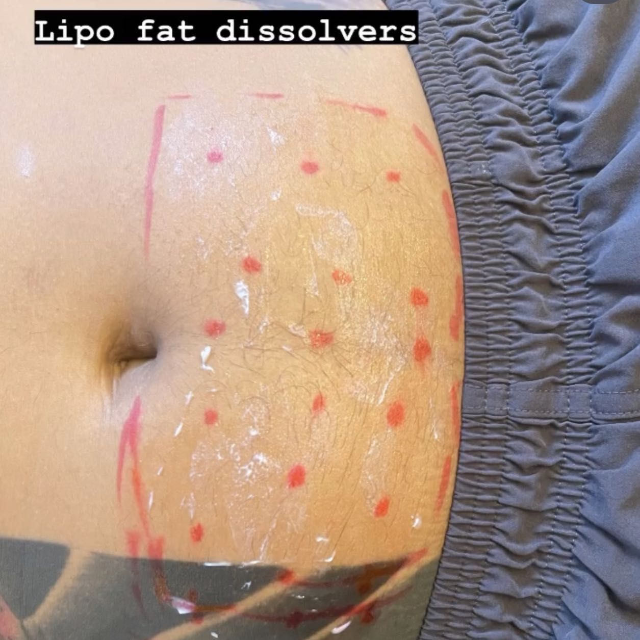 Fat dissolve Lipo Shots (lower belly) portfolio