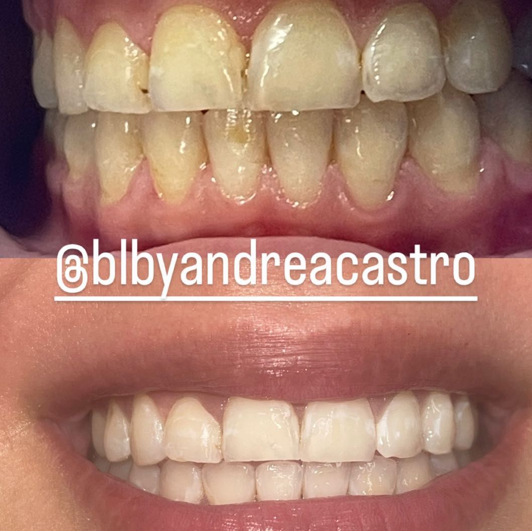 Teeth whitening (3sessions) portfolio