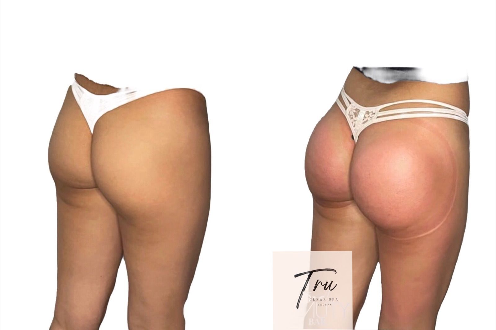 Advanced Body Sculpting - Colombian Butt Lift RESULTS 🔥 Are you looking to  enhance, lift and tone your buttocks? Our Colombian Butt Lift Treatment is  Perfect For YOU! 🍑 Our CBL Service