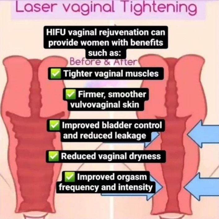 Virgo Season Special HIFU Vaginal Tightening Treat portfolio