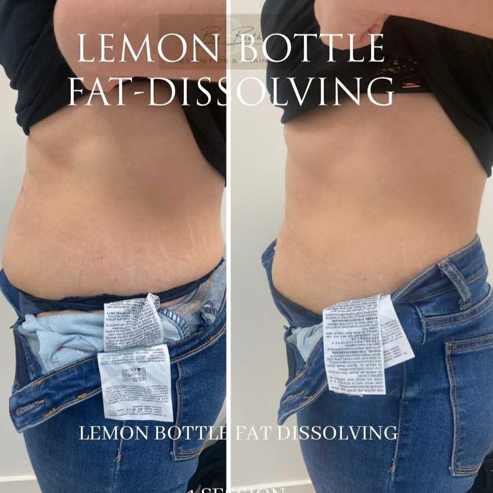 Lemon Bottle🍋 Fat Dissolving Serum portfolio