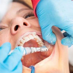Consultation For Teeth Whitening portfolio