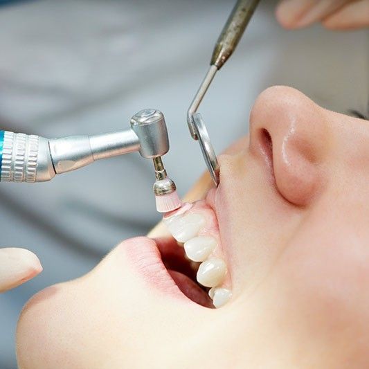 Consultation For Teeth Whitening portfolio