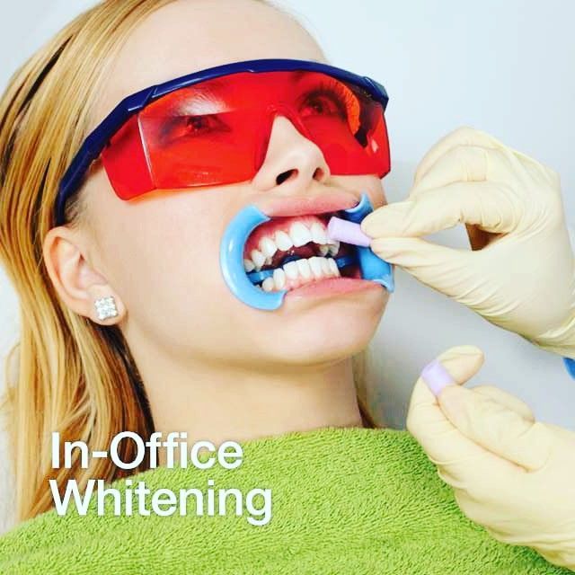 After consultation Teeth whitening first visit portfolio