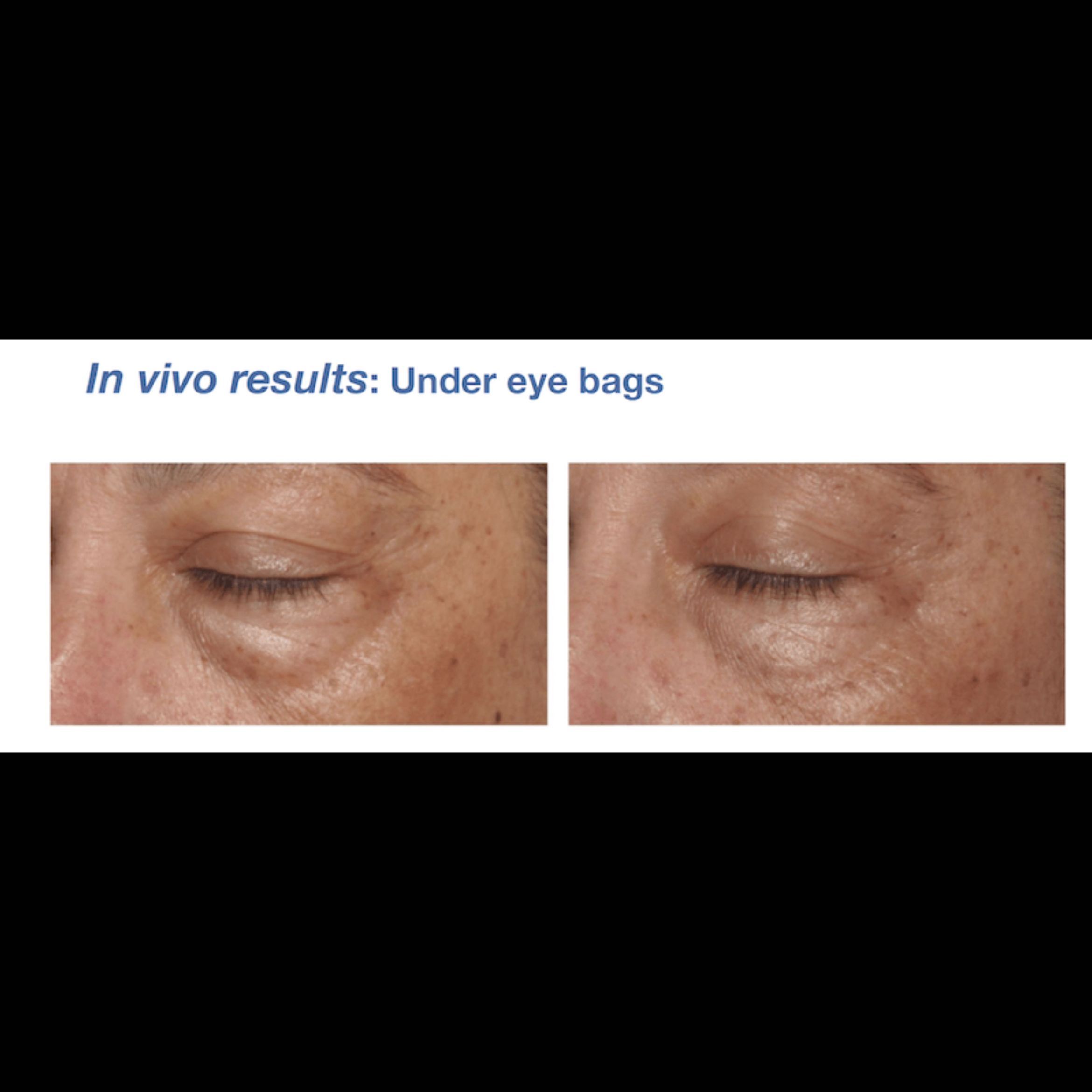 Eye rejuvenation treatment set of 5 portfolio