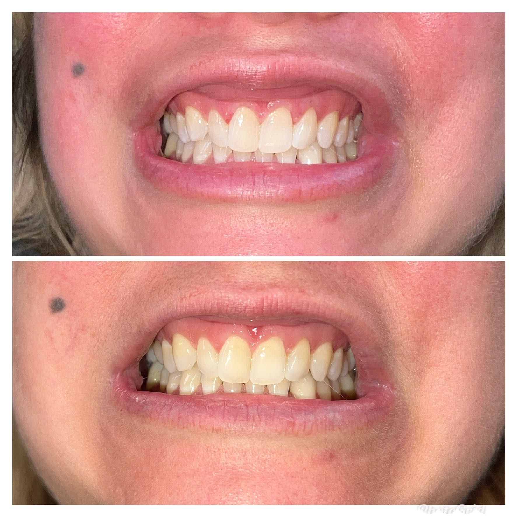 Add On: Teeth Whitening portfolio