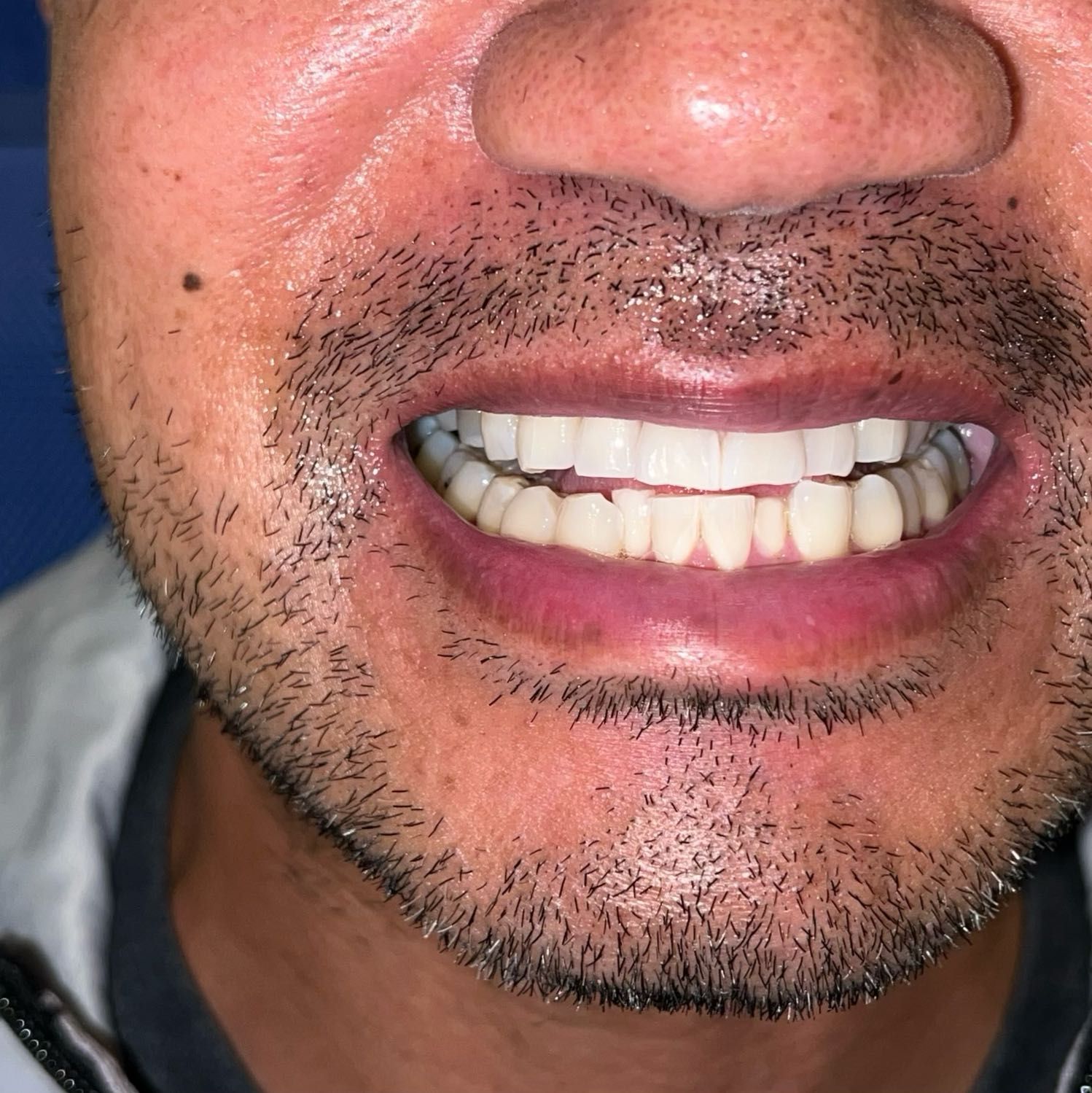 Teeth Whitening Plus Sealer portfolio
