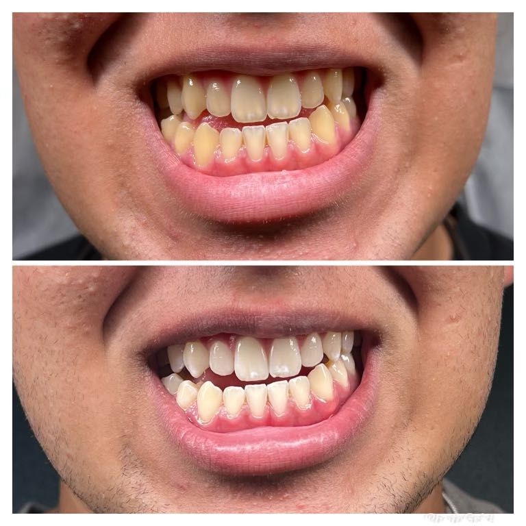Add On: Teeth Whitening portfolio