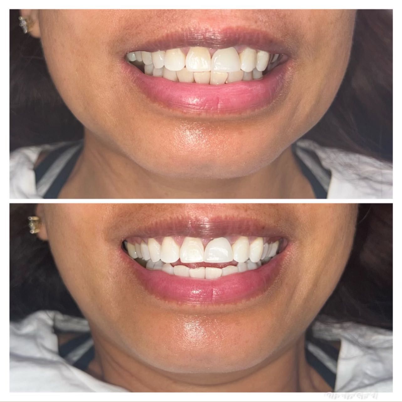 Teeth Whitening Plus Sealer portfolio