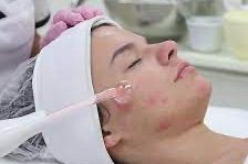 Acne Treatment / Tratamiento acne portfolio