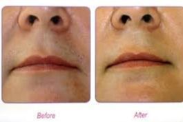 Upper Lip Laser Hair Removal portfolio
