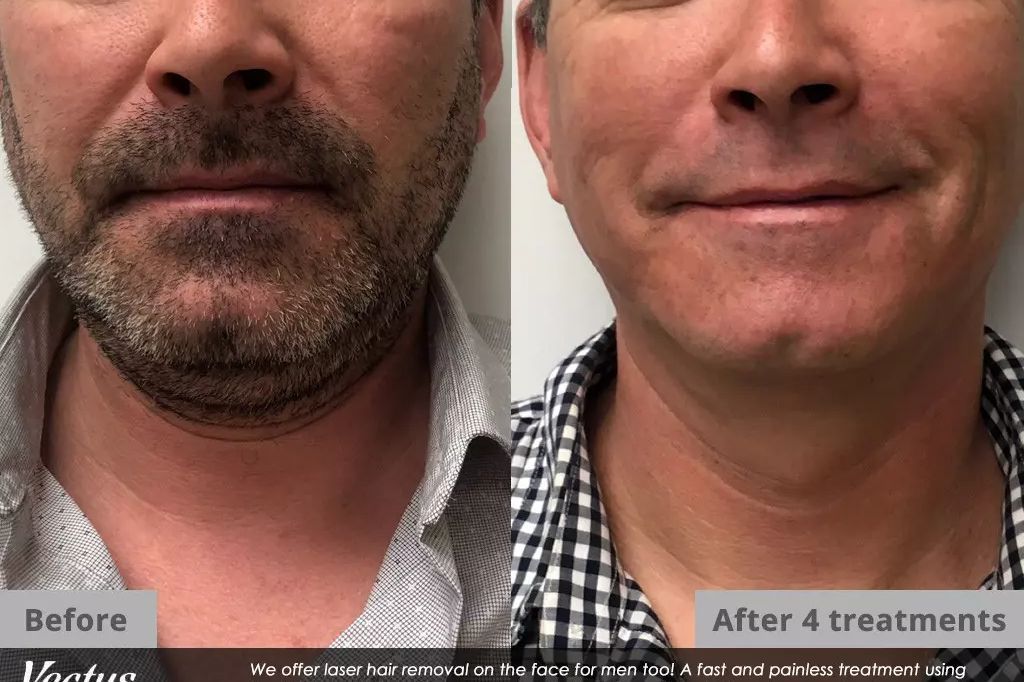 Full Face and Neck Laser Hair Removal portfolio