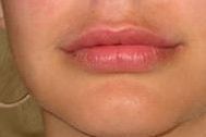 Lip augmentation without surgery portfolio