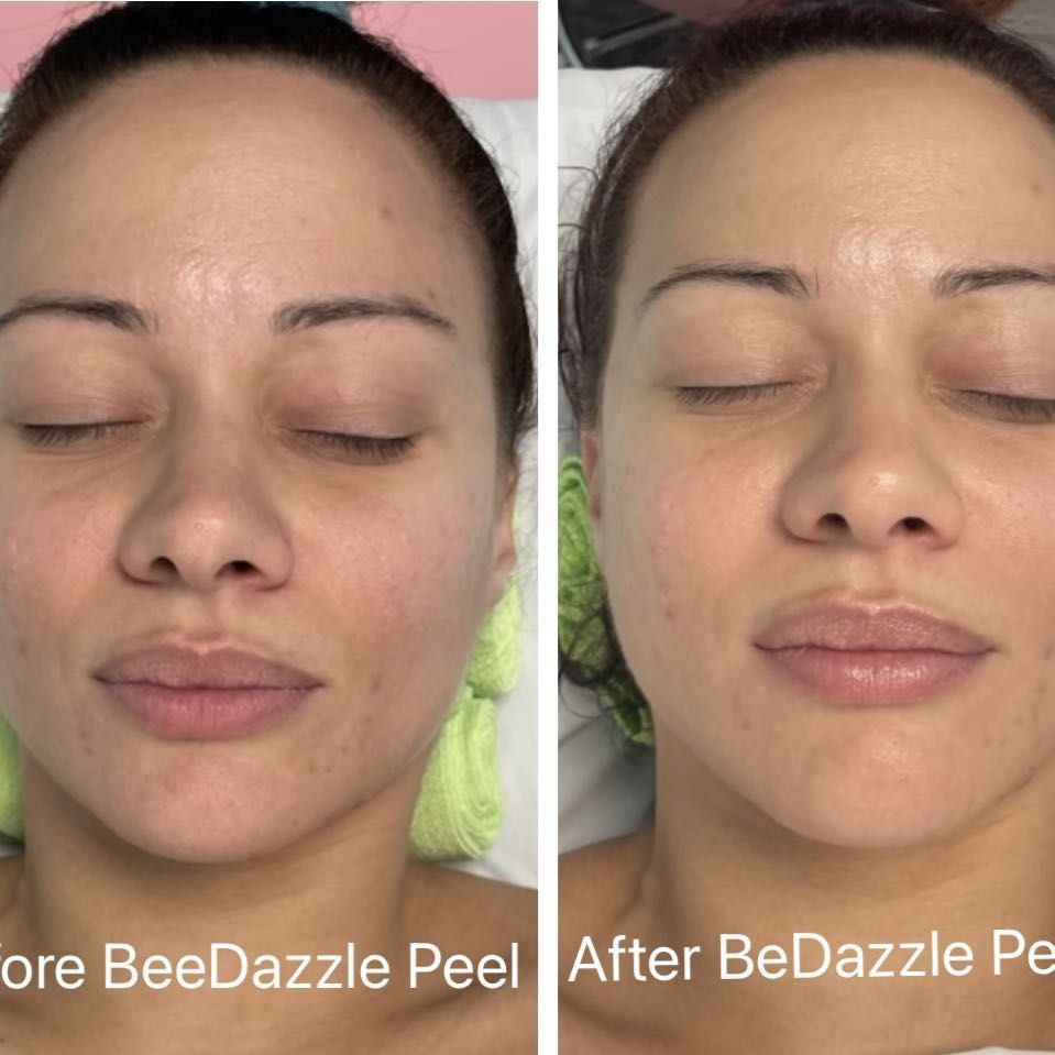 Gentle BeeDazzle Peel (add onto facial) portfolio