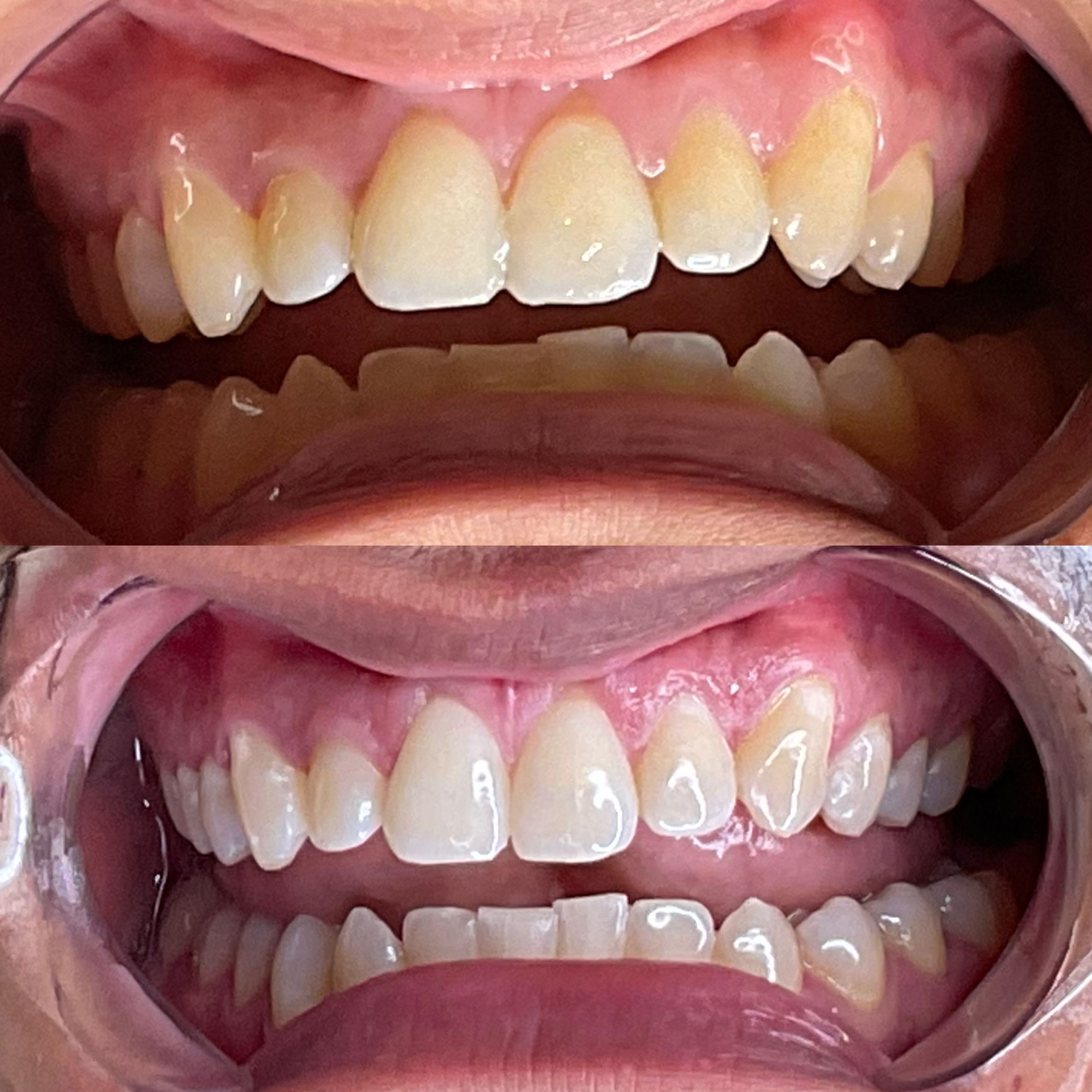 Teeth Whitening/60min portfolio