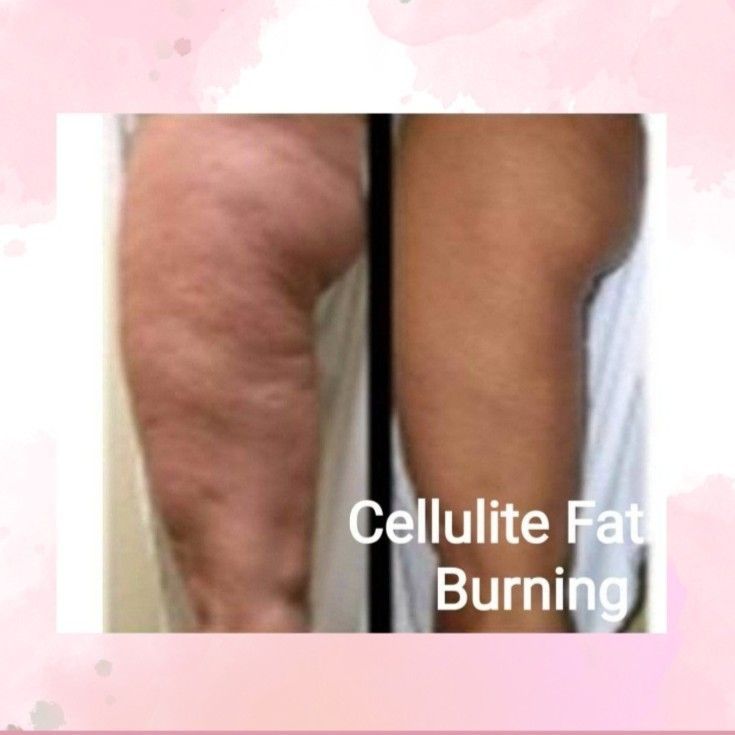 Cellulite Reducing portfolio