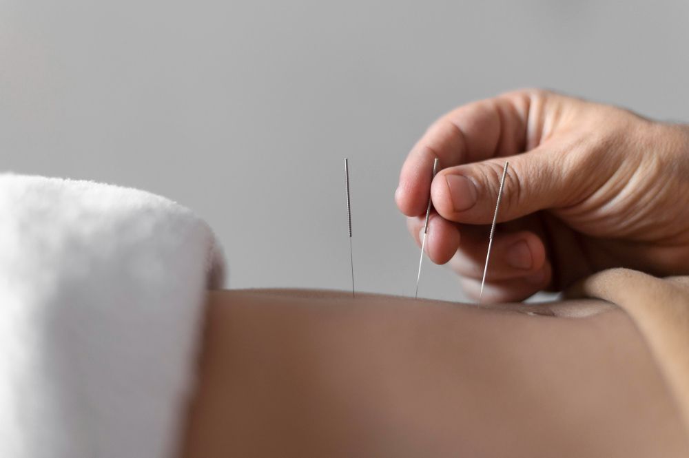 Fertility acupuncture near you