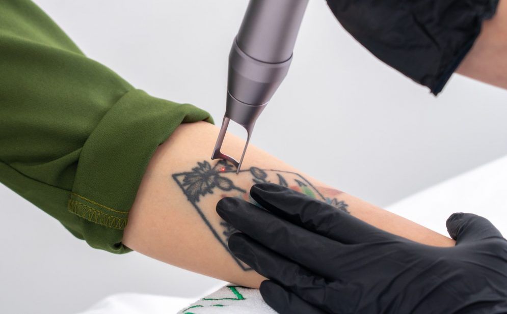 Tattoo Removal Nearby