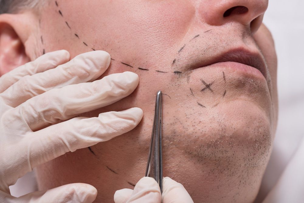 What is a hair transplant?